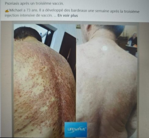 Dos d'un homme présentant des lésions cutanées marquées sur la peau.